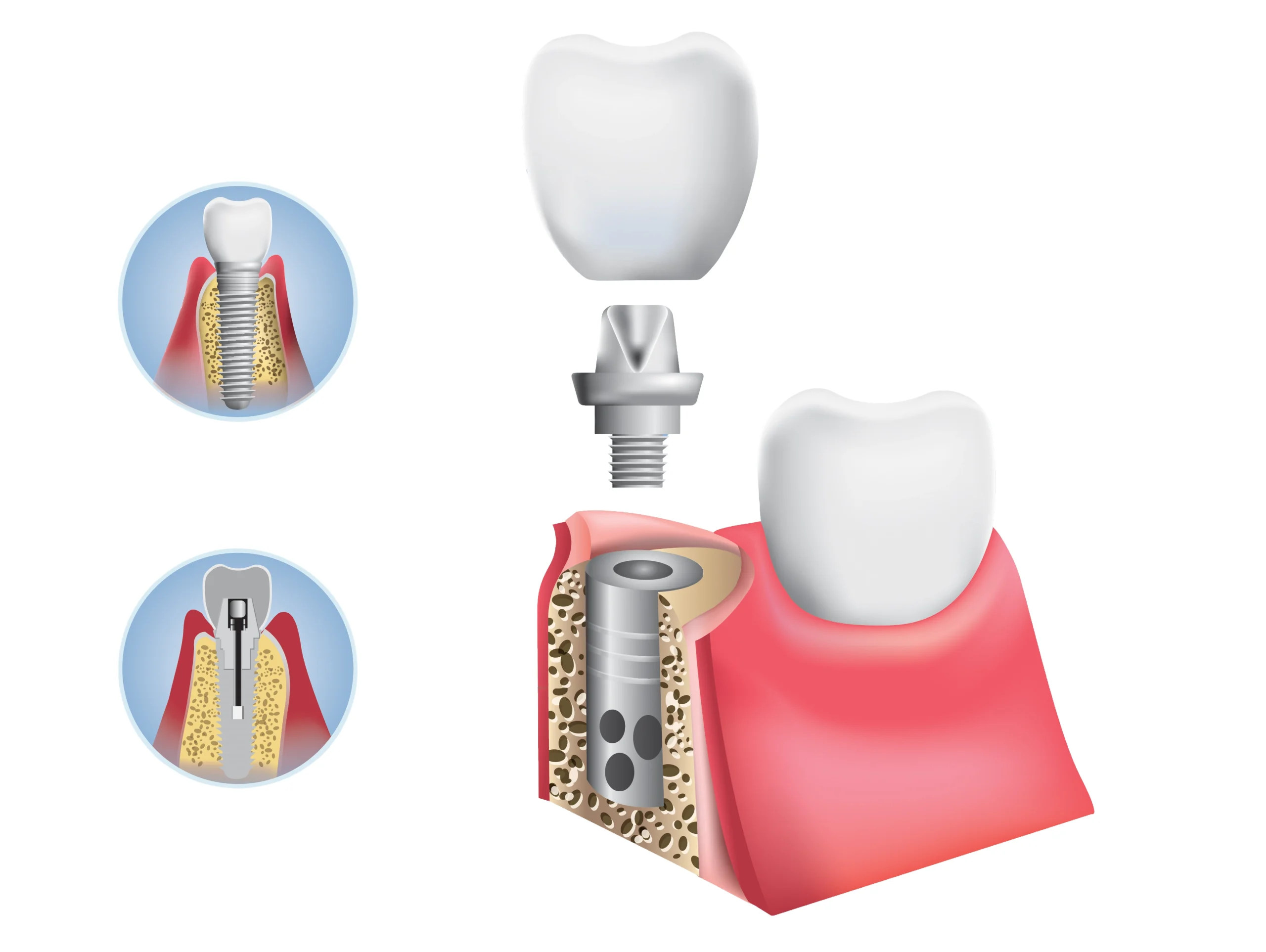 6 عارضه احتمالی لیفت سینوس و تأثیر آن بر موفقیت ایمپلنت