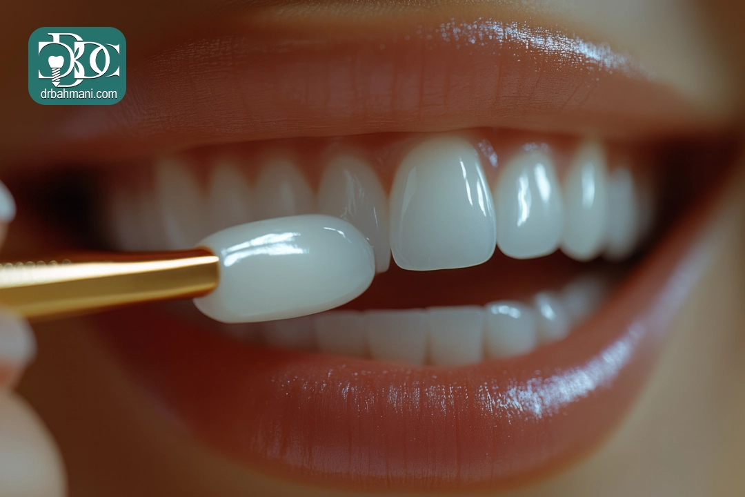 6 فرق کامپوزیت ونیر و لمینت سرامیکی؛ کاربرد کامپوزیت ونیر چیست؟