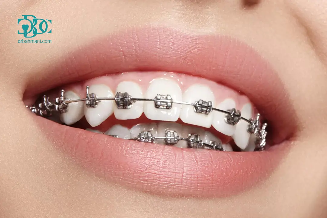 مقایسه ارتودنسی ثابت و متحرک از نظر هزینه، طول درمان و نتیجه نهایی