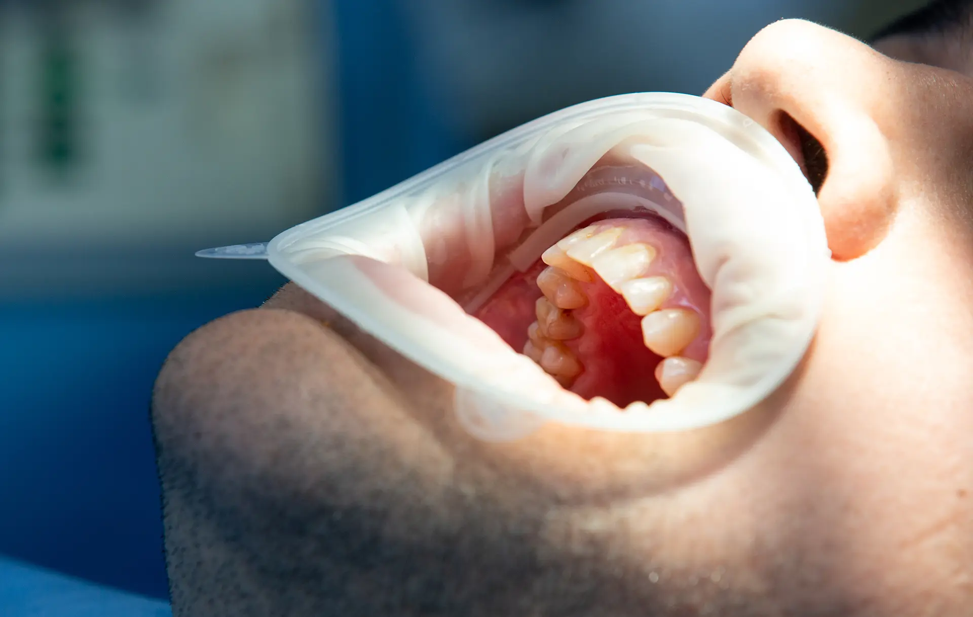 پیوند استخوان فک برای ایمپلنت دندان؛ واقعاً چه زمانی لازم می‌شود؟