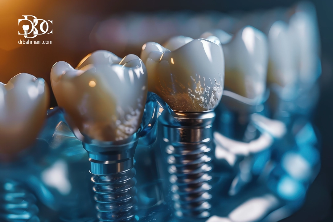 پیوند استخوان فک برای ایمپلنت دندان؛ واقعاً چه زمانی لازم می‌شود؟