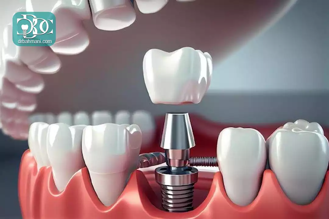 معایب و محدودیت های ایمپلنت دندان
