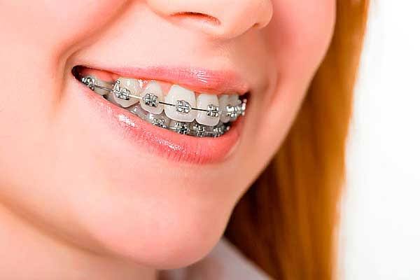 مراقبت های مهم بعد از ارتودنسی دندان