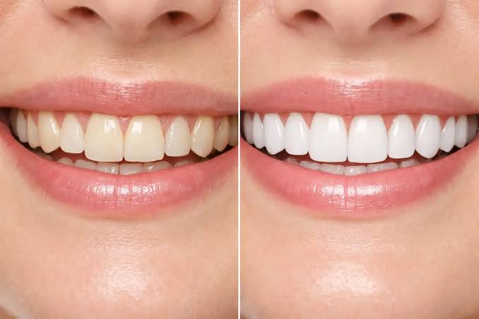 لمینت سرامیکی برای چه کسانی مناسب است؟