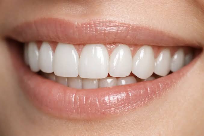 لمینت سرامیکی برای چه کسانی مناسب است؟