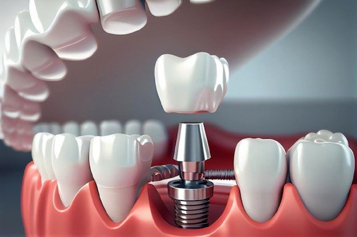 معایب و محدودیت های ایمپلنت دندان