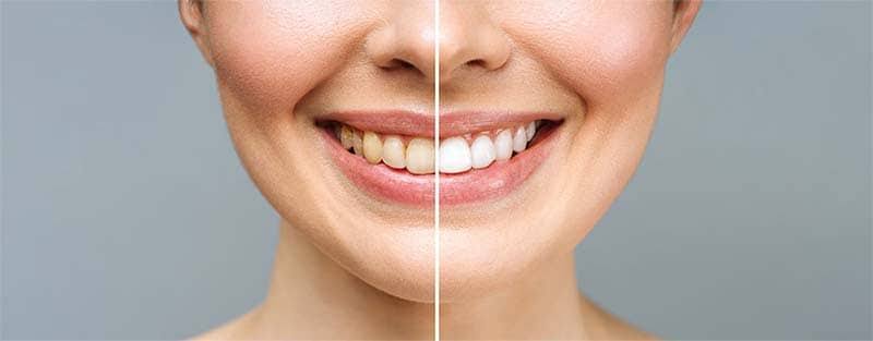چگونه از دندان های خود بعد از بلیچینگ مراقبت کنیم؟