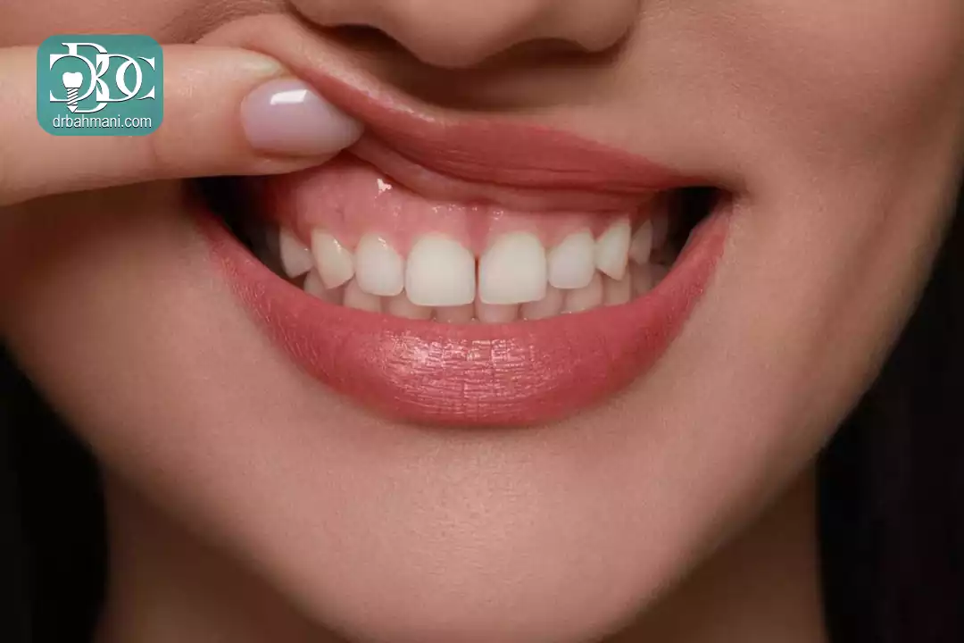 قبل از طراحی لبخند چه نکاتی را باید بدانید؟
