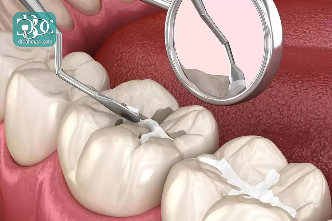 بهترین زمان برای پر کردن دندان چه وقتی است؟