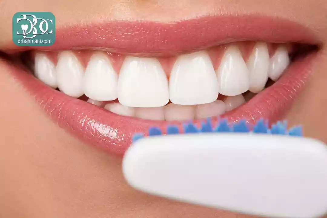 راهنمای کامل مراقبت های بعد از کامپوزیت ونیر