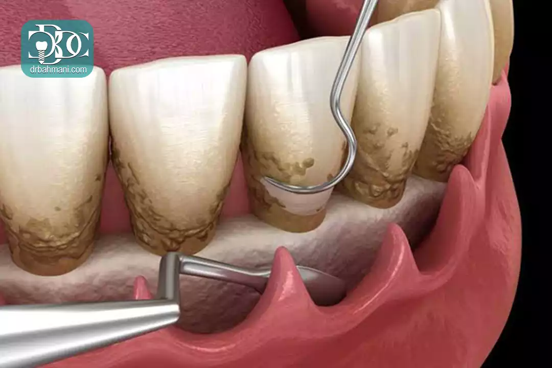 چه زمانی به جراحی لثه نیاز پیدا می‌کنیم؟