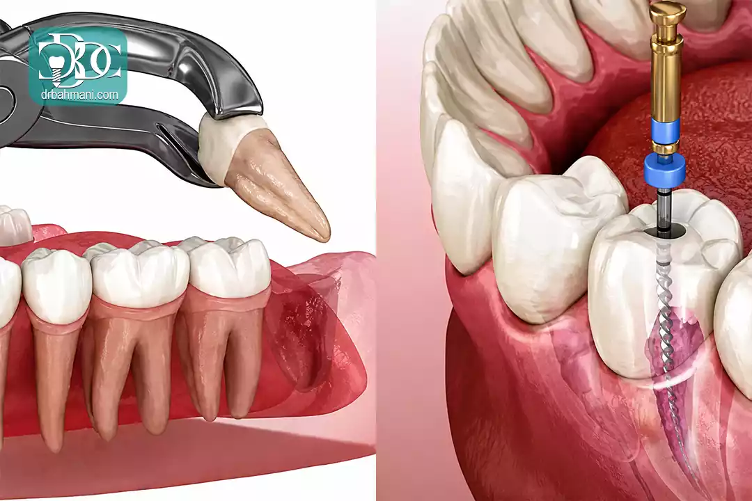 عصب کشی دندان بهتر است یا کشیدن؟ مقایسه جامع و تخصصی