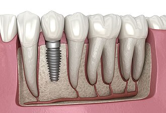 کدام روش کاشت ایمپلنت دندان بهتر است؟