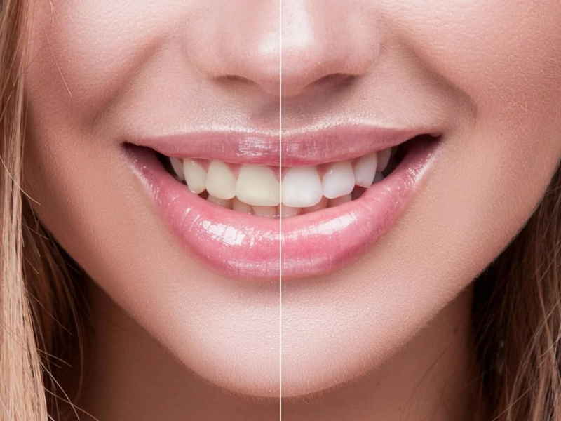 بعد از بلیچینگ دندان چه بخوریم و چه نخوریم؟