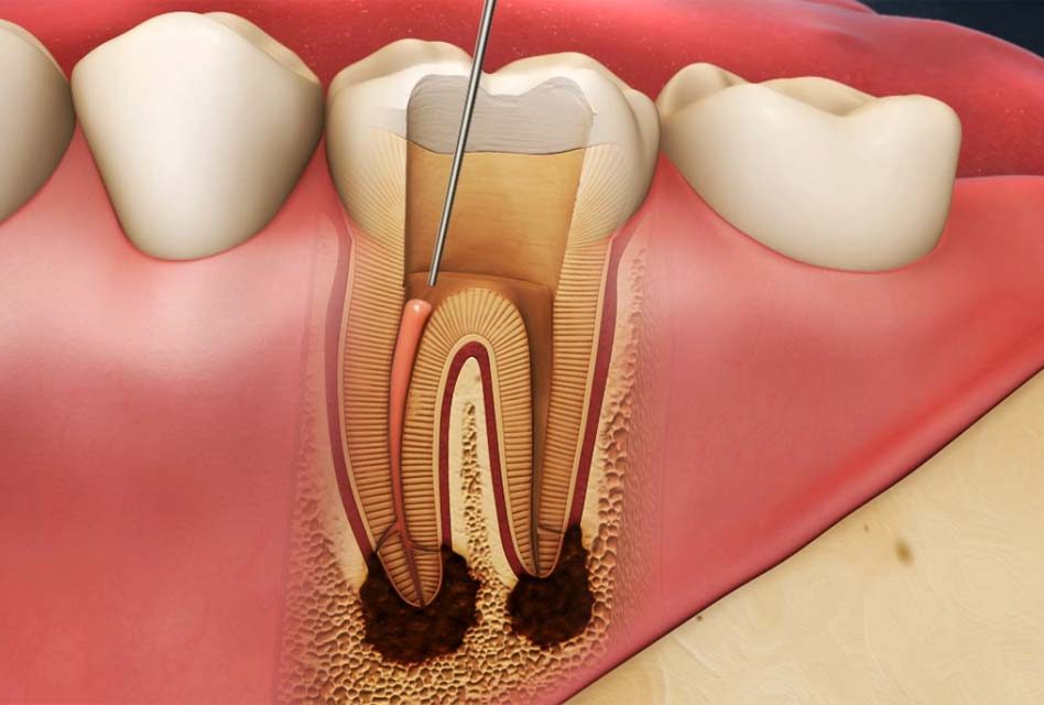 نشانه های موفقیت آمیز بودن عصب کشی دندان چیست؟
