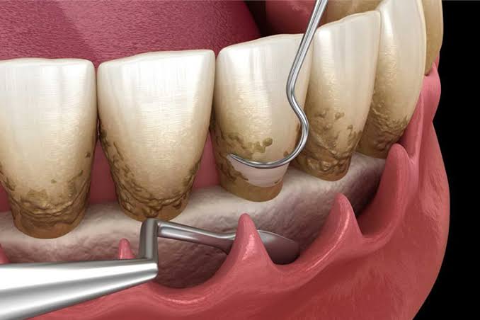 چه زمانی به جراحی لثه نیاز پیدا می‌کنیم؟