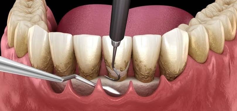 چه زمانی به جراحی لثه نیاز پیدا می‌کنیم؟