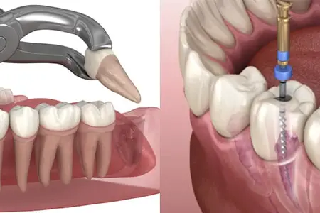 عصب کشی دندان بهتر است یا کشیدن؟ مقایسه جامع و تخصصی