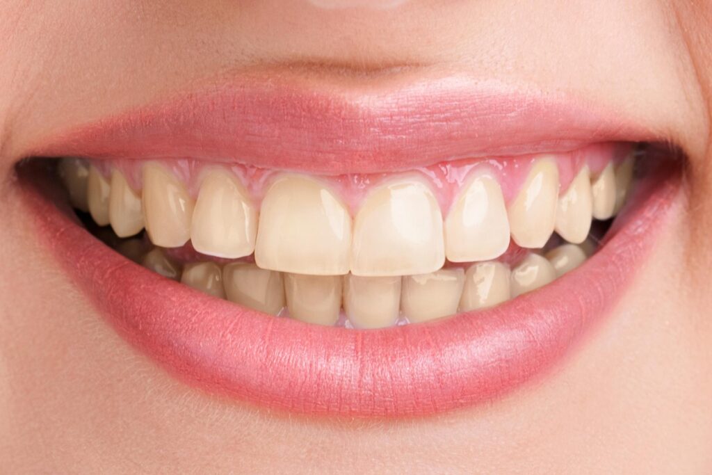 قبل از طراحی لبخند چه نکاتی را باید بدانید؟