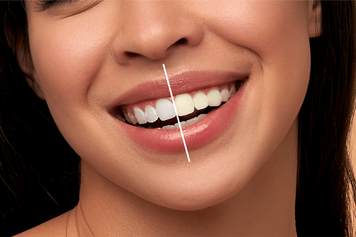 قبل از طراحی لبخند چه نکاتی را باید بدانید؟