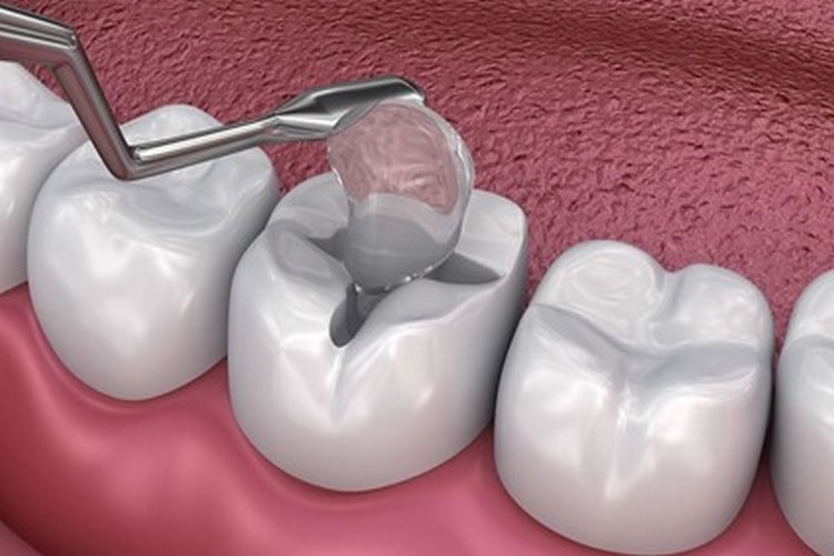 بهترین زمان برای پر کردن دندان چه وقتی است؟