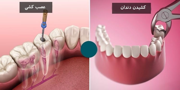 عصب کشی دندان بهتر است یا کشیدن؟ مقایسه جامع و تخصصی